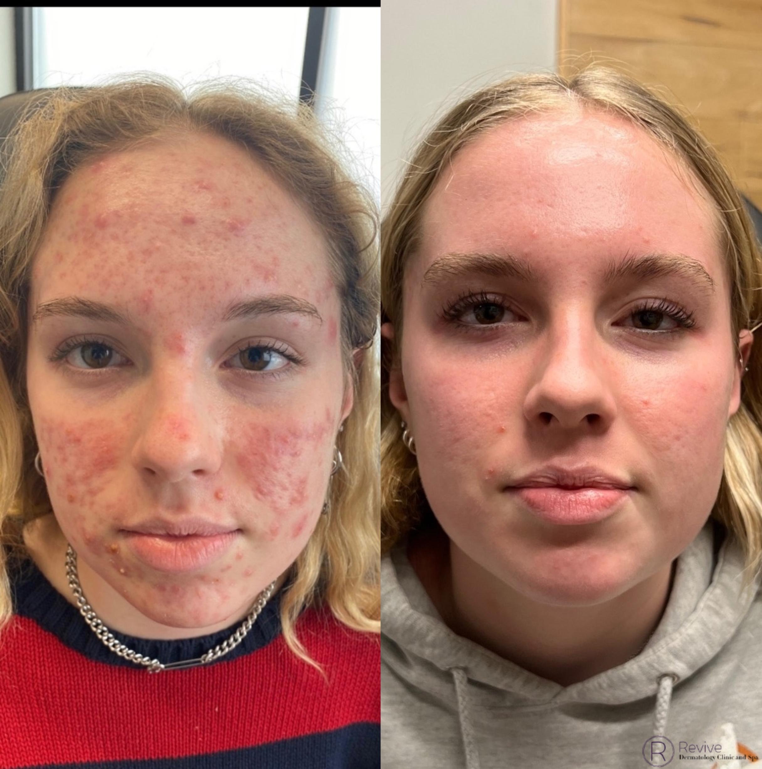Teenage Acne Before and After