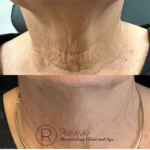 Thumbnail of http://Neck%20laxity%20treated%20with%20Botox
