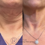Thumbnail of http://Neck%20laxity%20treated%20with%20Botox
