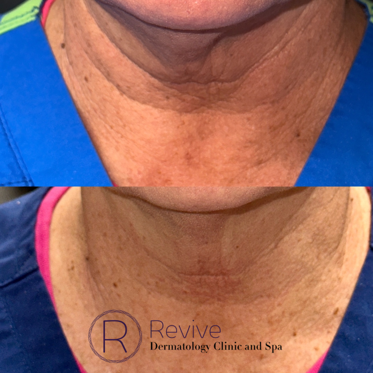 Neck laxity treated with MicroTox®