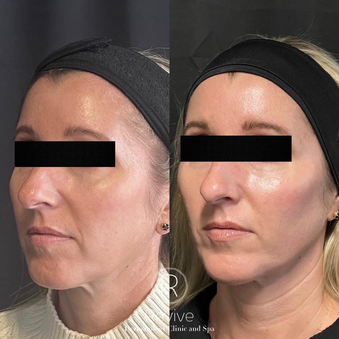Full Face Rejuvenation with Cosmetic fillers and Botox
