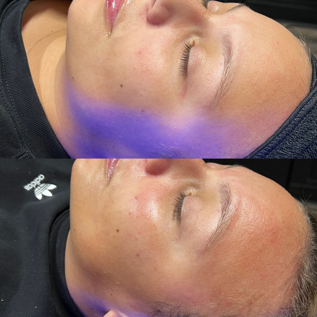 before and after hydrafacial