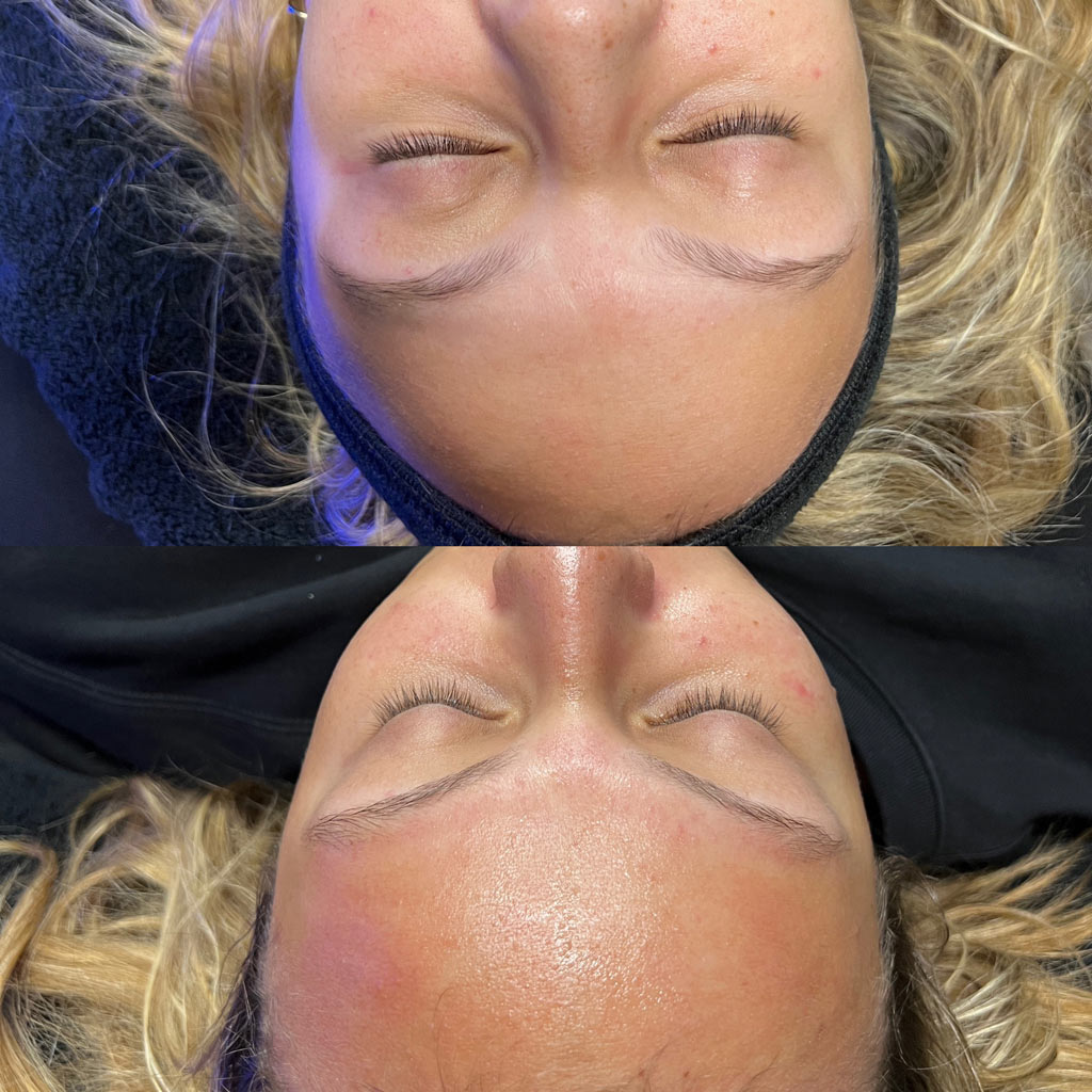 before and after hydrafacial