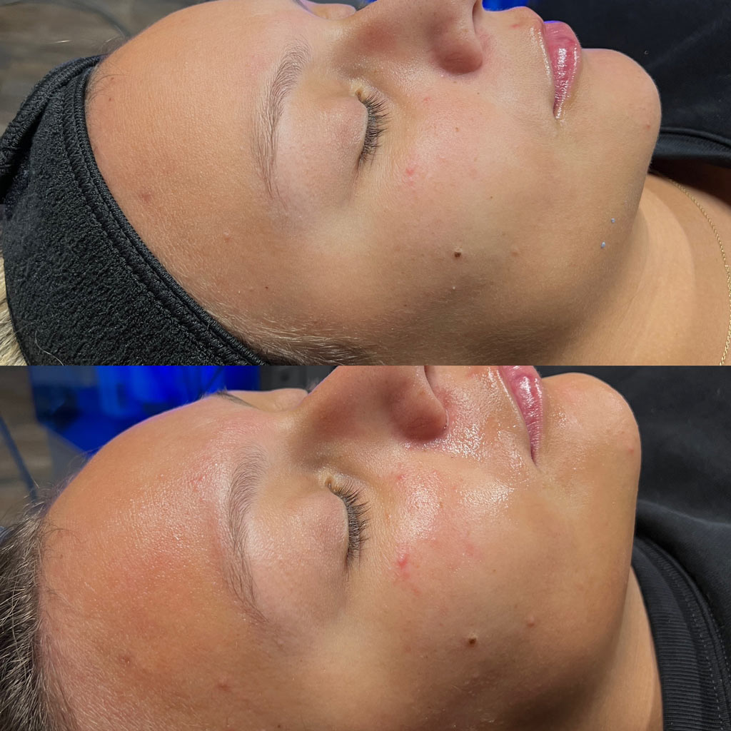 before and after hydrafacial