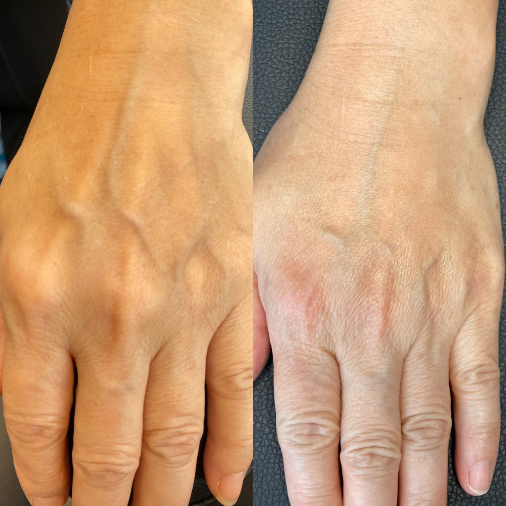 before and after sculptra