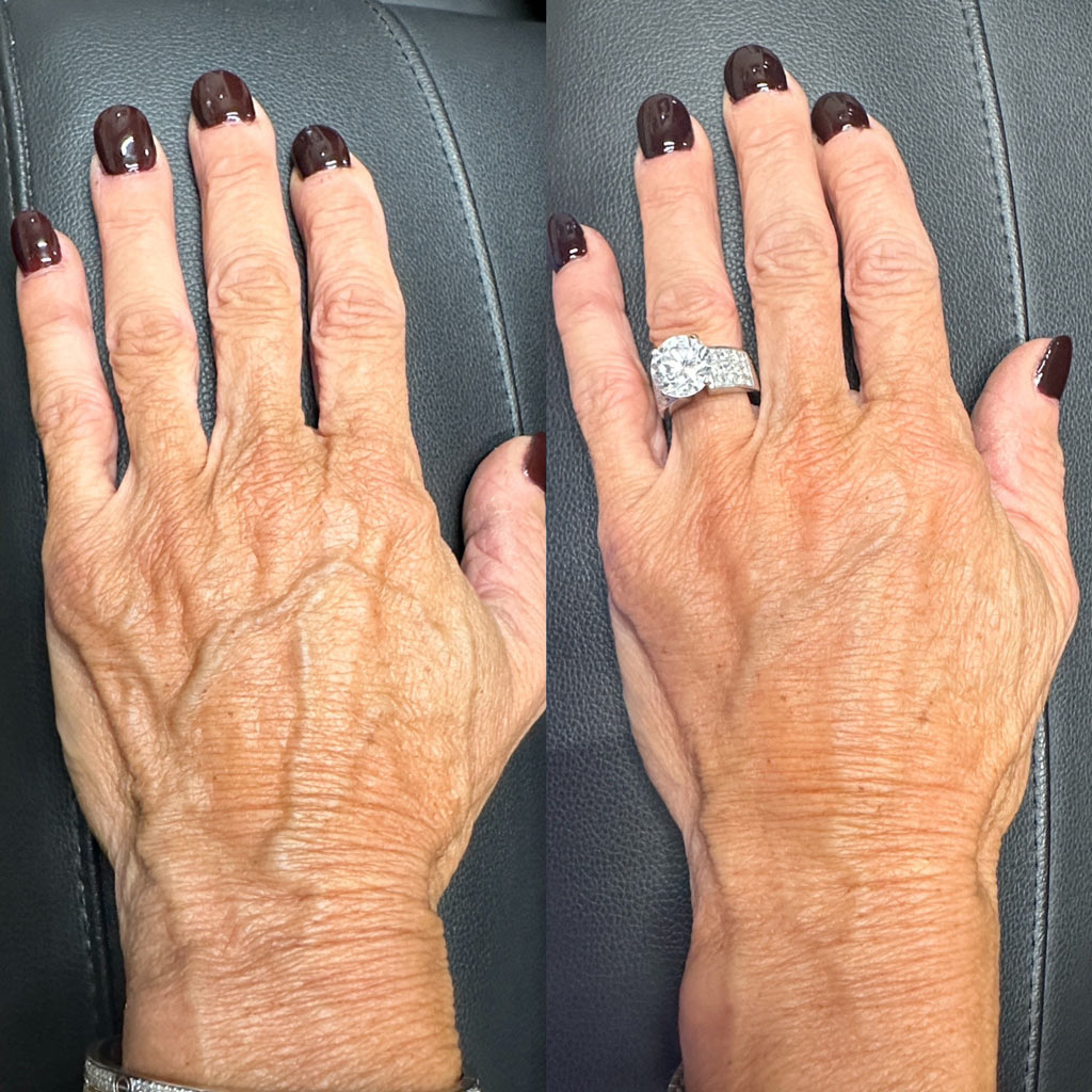 before and after sculptra