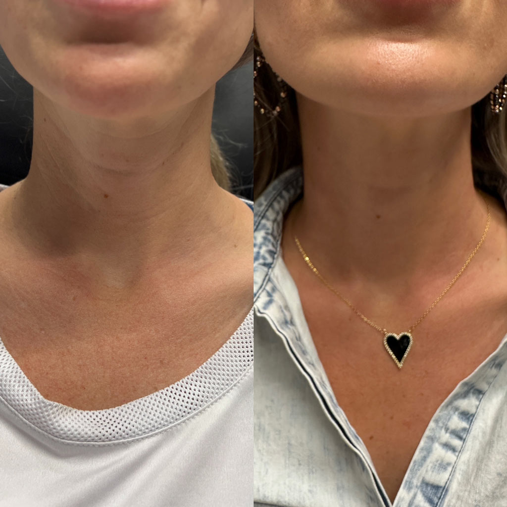 before and after sculptra