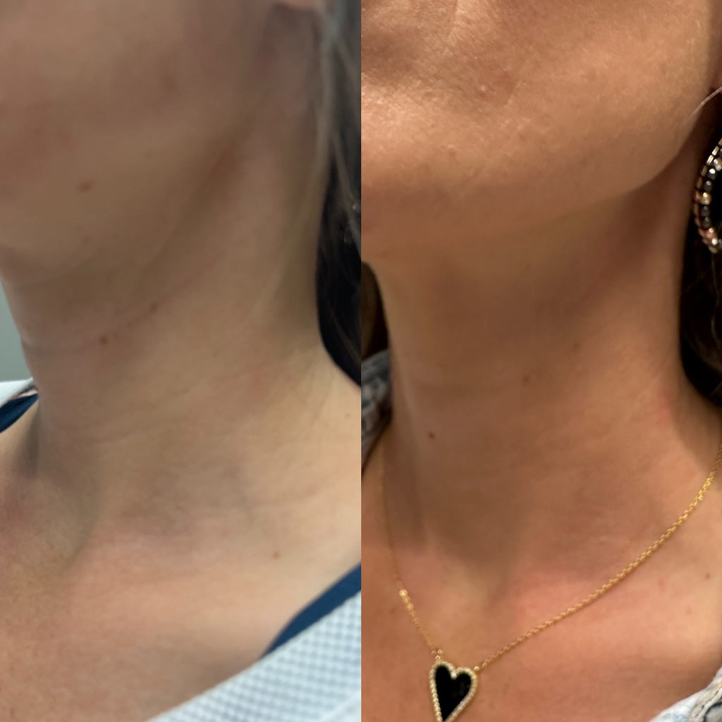 before and after sculptra