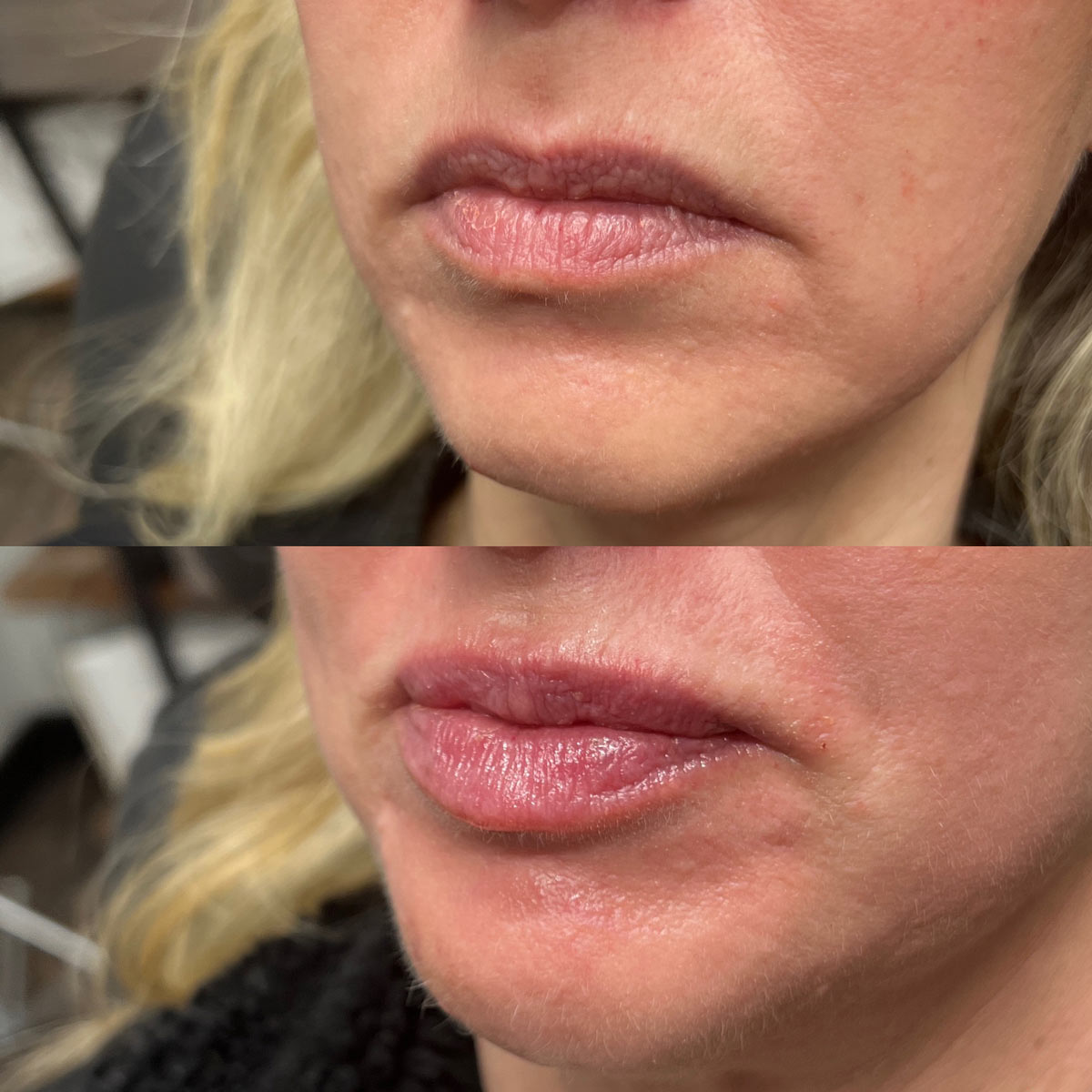 revive-lip-filler-before-after-1