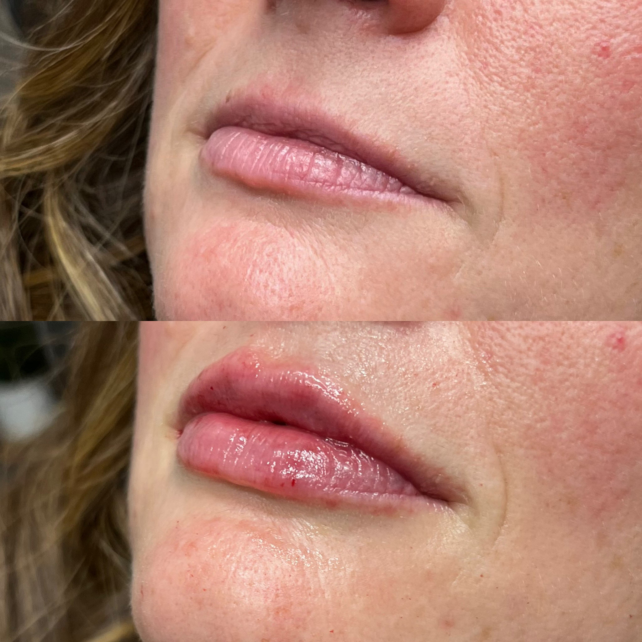 revive-lip-filler-before-after-10