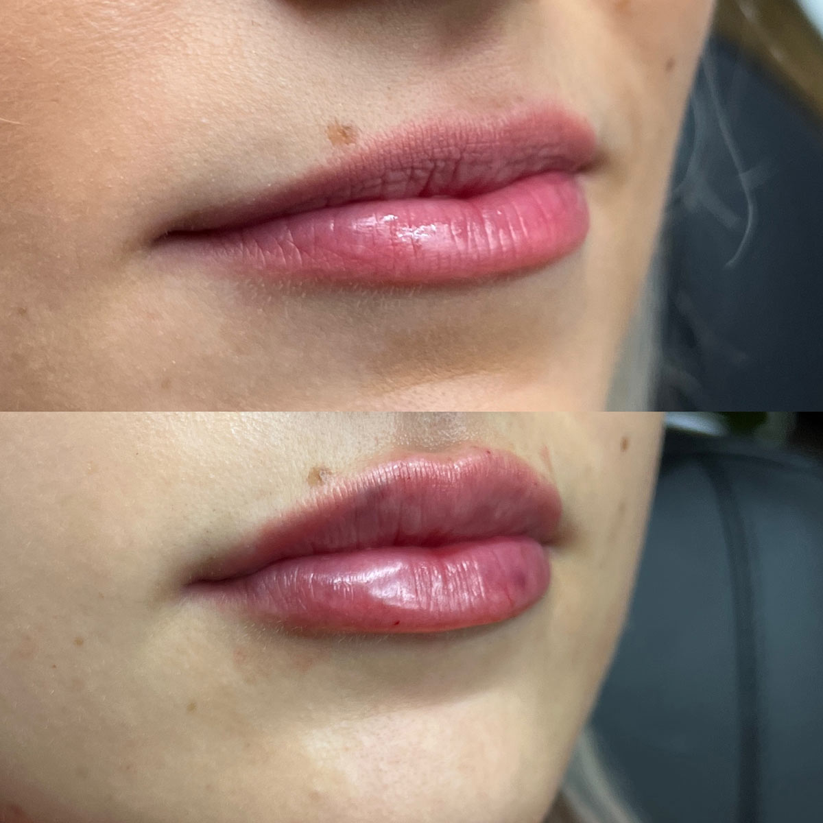 revive-lip-filler-before-after-11