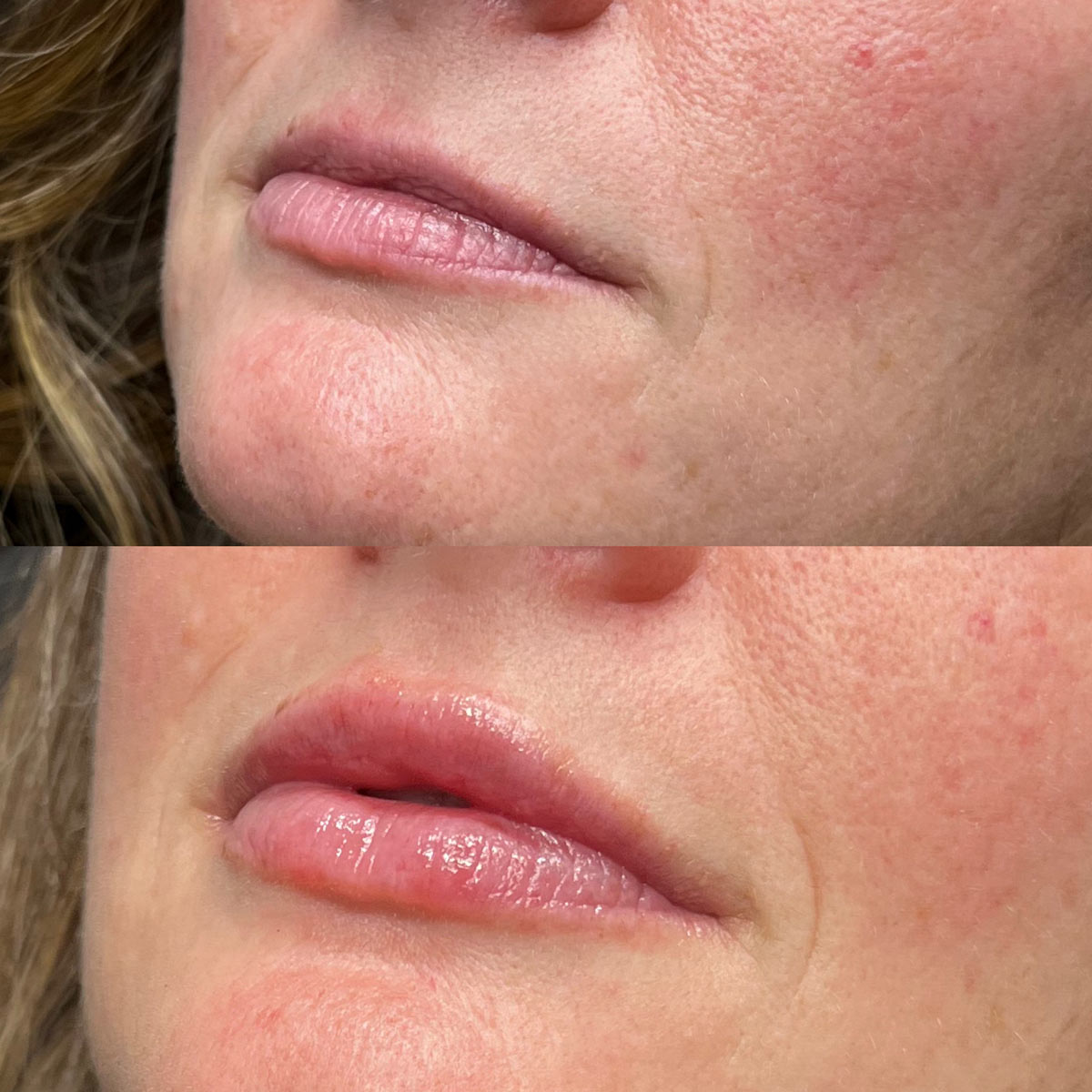 revive-lip-filler-before-after-12