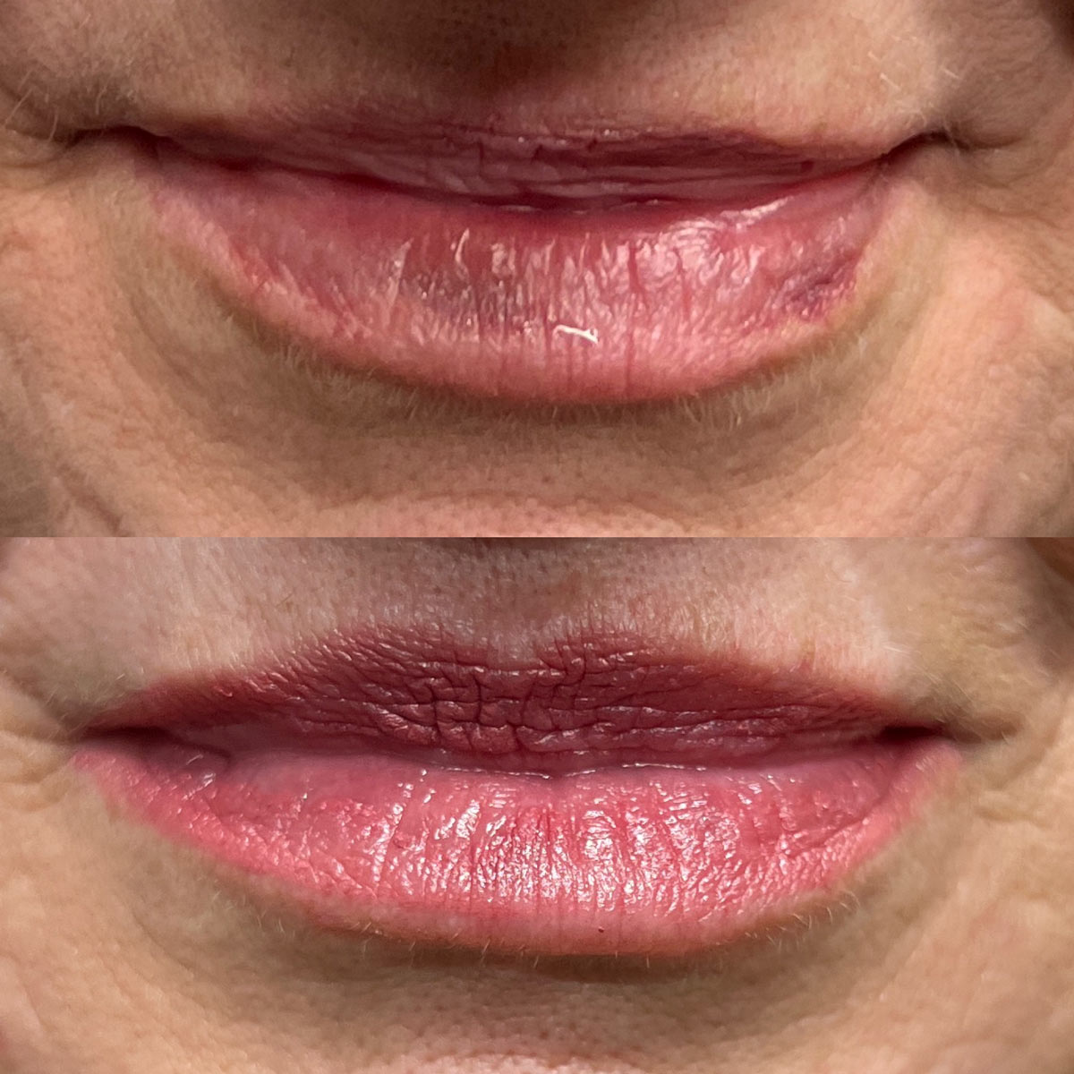 revive-lip-filler-before-after-13