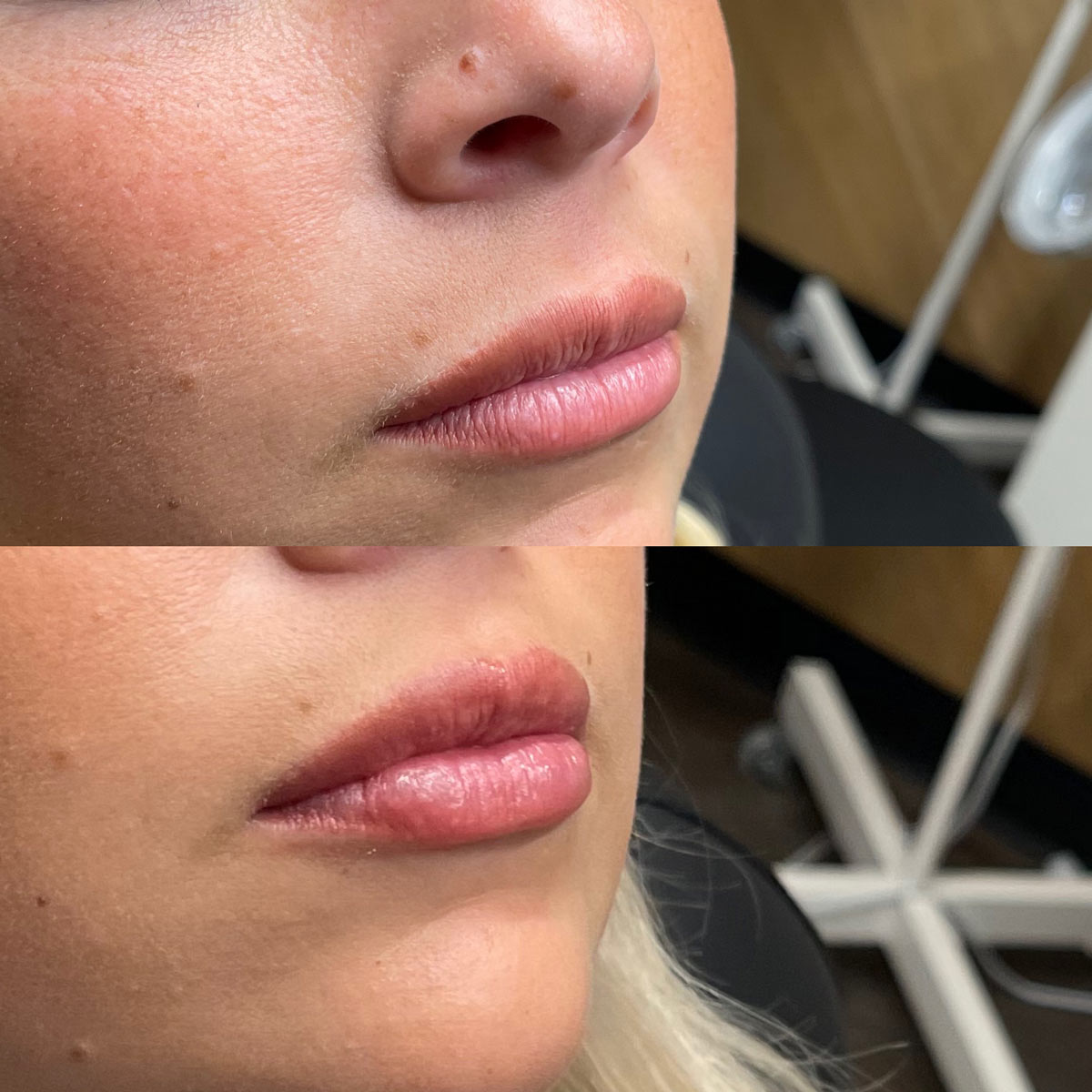 revive-lip-filler-before-after-14