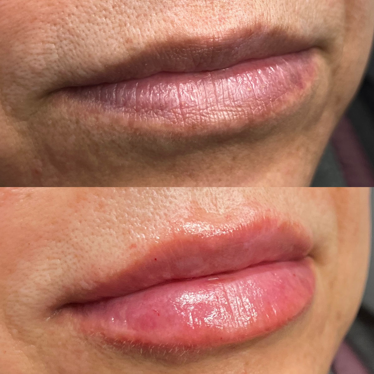 revive-lip-filler-before-after-15