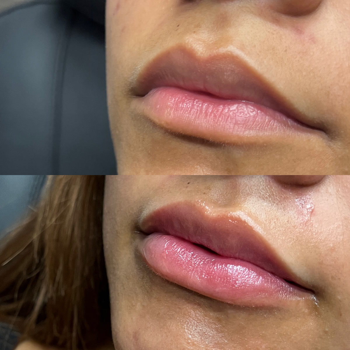 revive-lip-filler-before-after-16