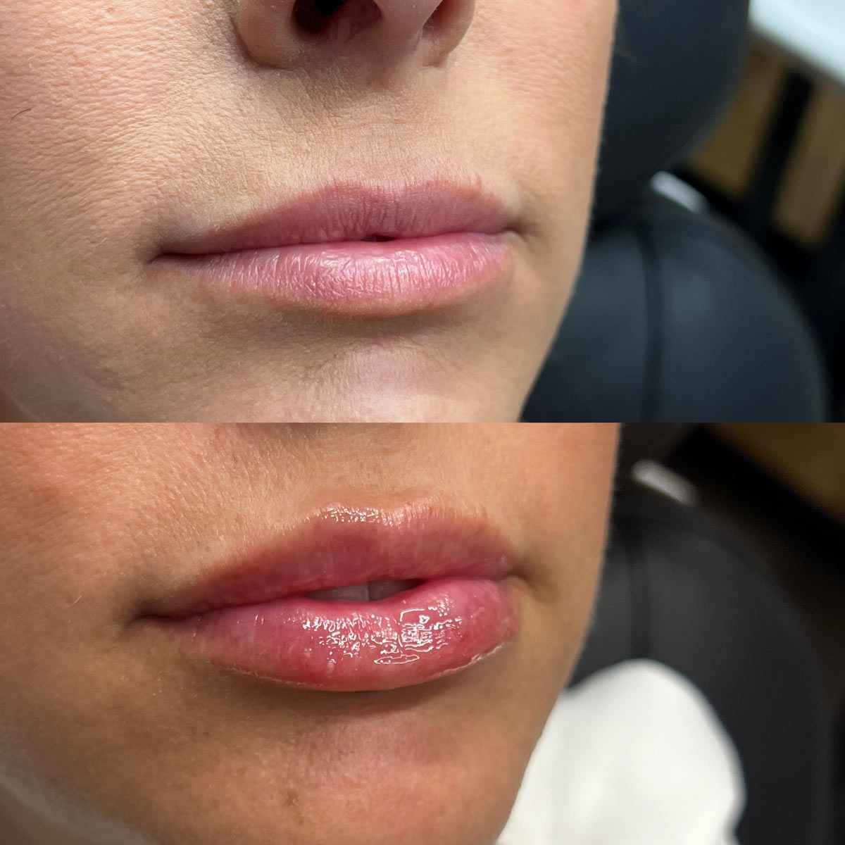 revive-lip-filler-before-after-17