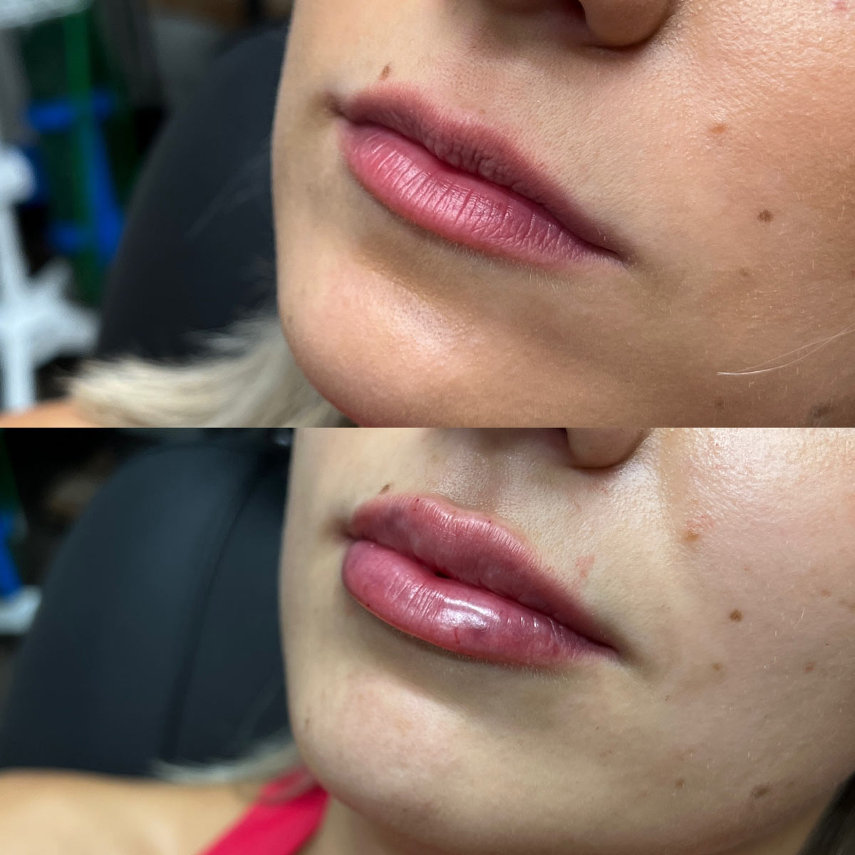 revive-lip-filler-before-after-18