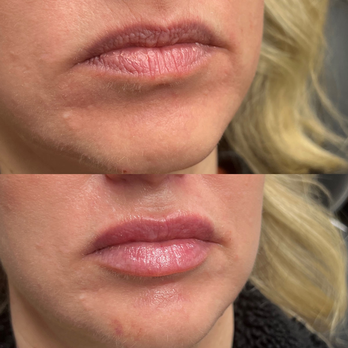 revive-lip-filler-before-after-19