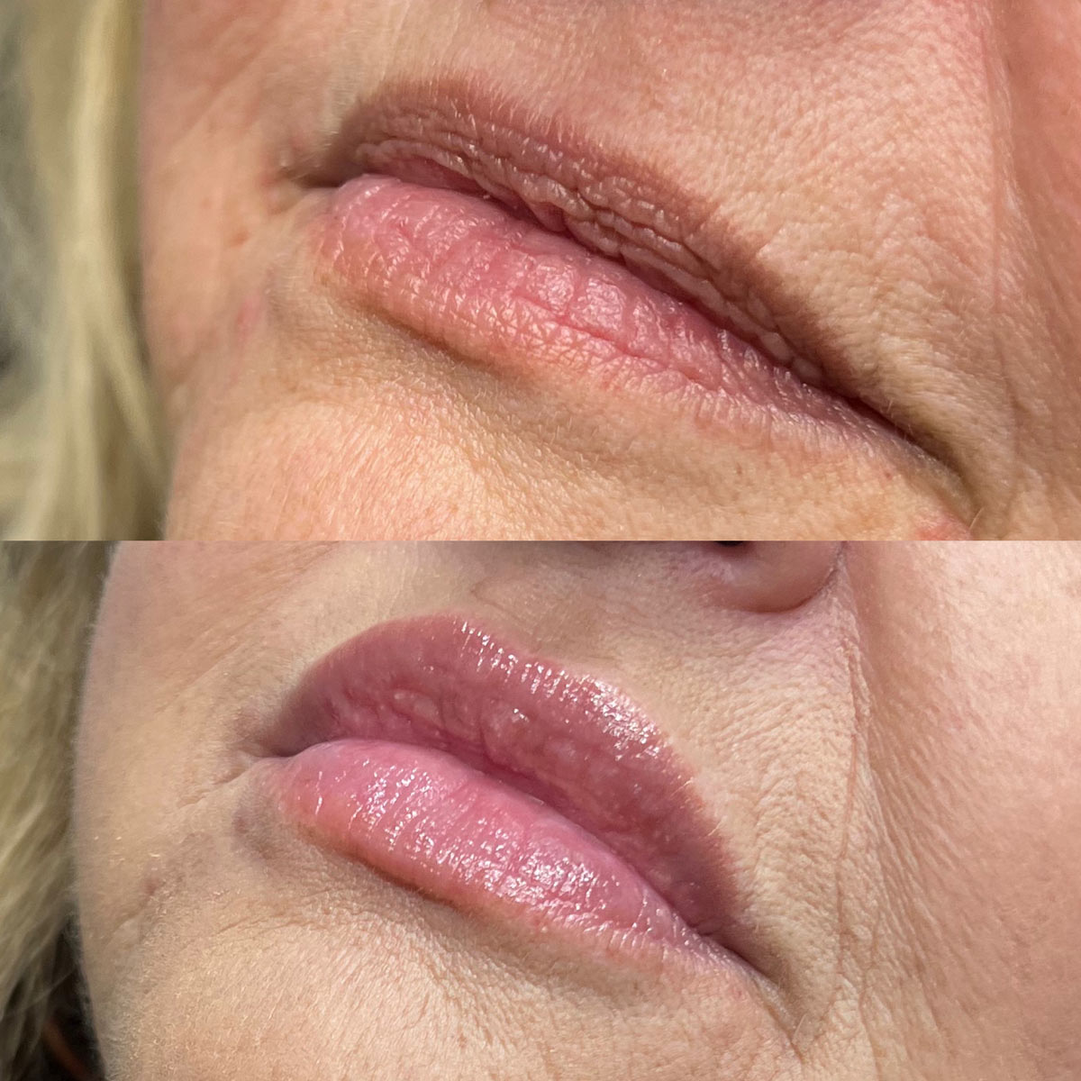 revive-lip-filler-before-after-2