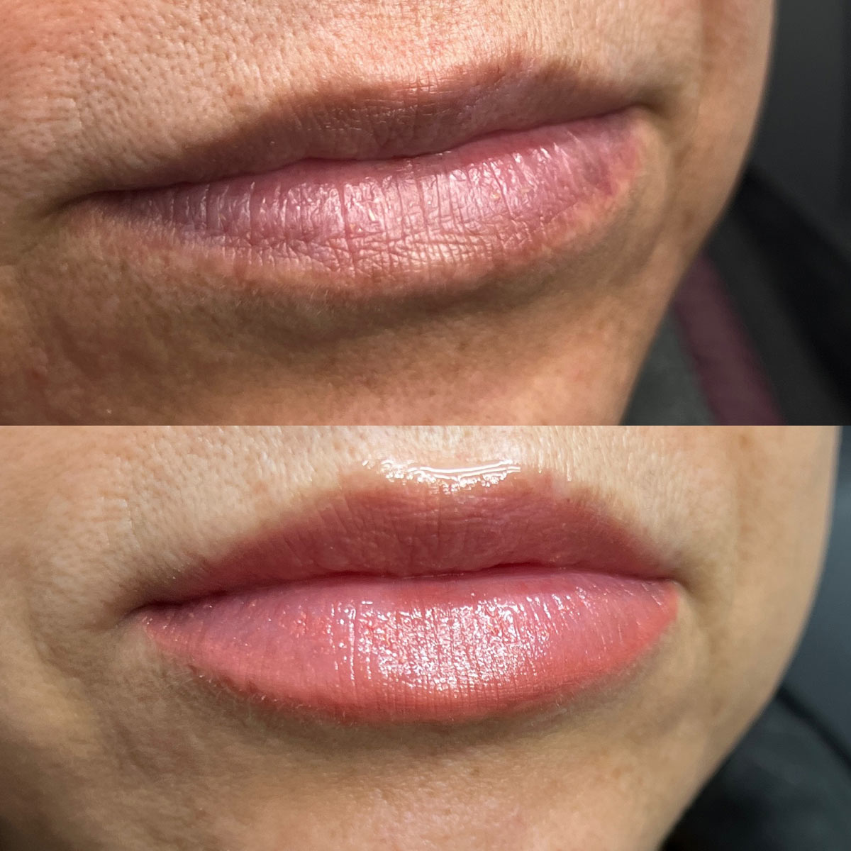 revive-lip-filler-before-after-3