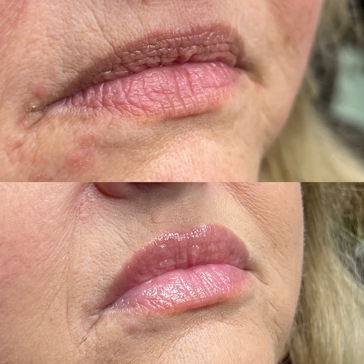 revive-lip-filler-before-after-4