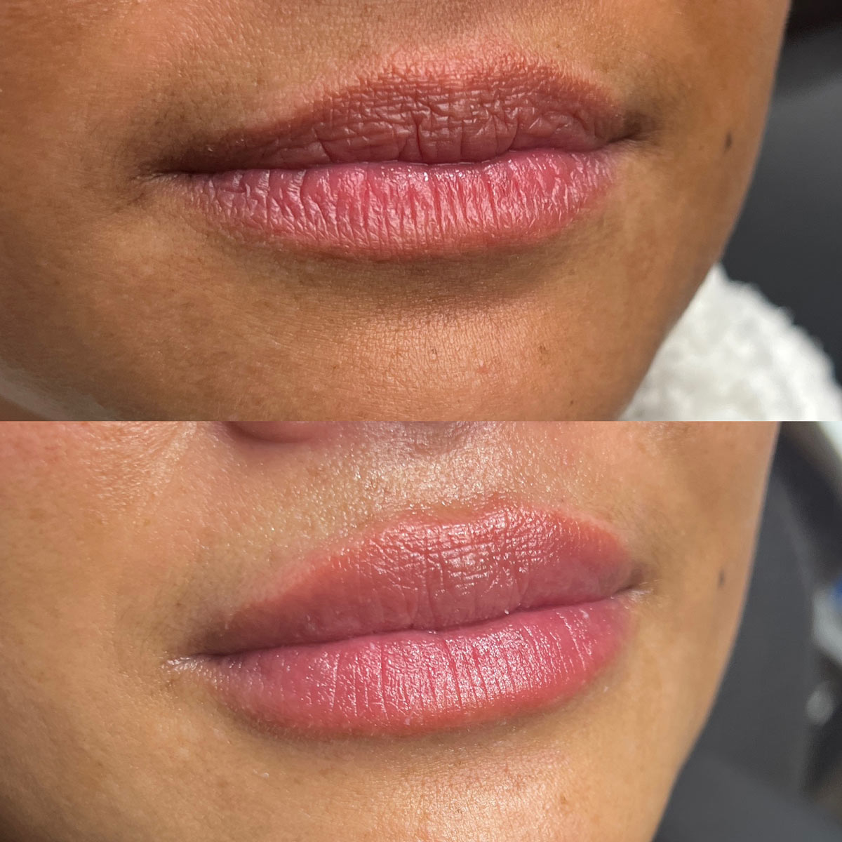 revive-lip-filler-before-after-5