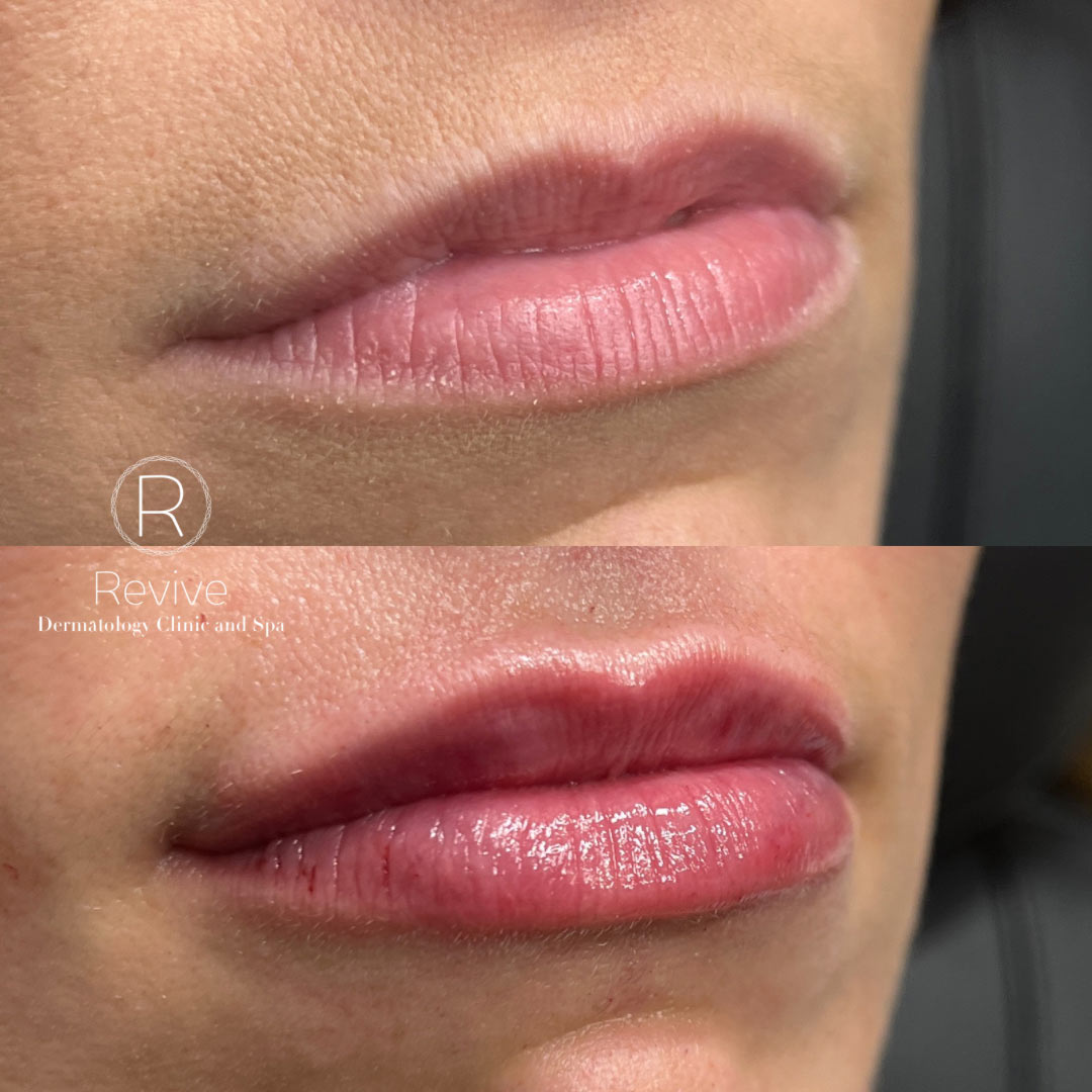 revive-lip-filler-before-after-6