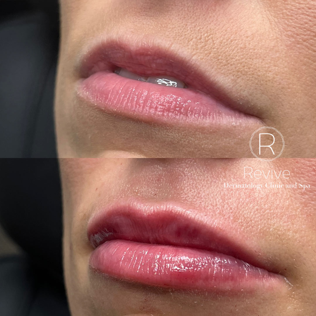 revive-lip-filler-before-after-7