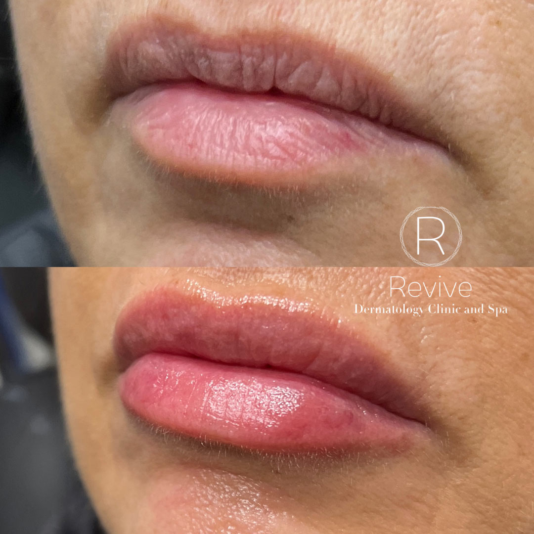 revive-lip-filler-before-after-8