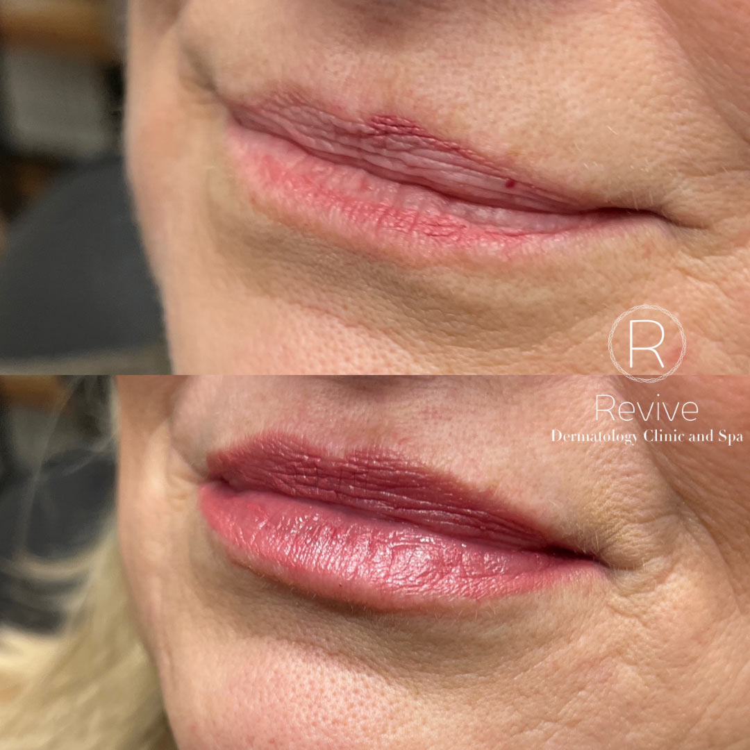 revive-lip-filler-before-after-9