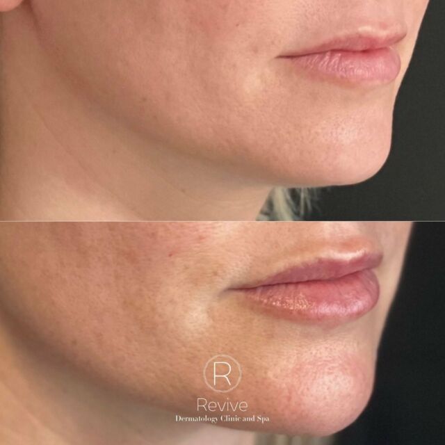 Lips to die for 💋💉😍
#filler #injections #injector #aesthetics