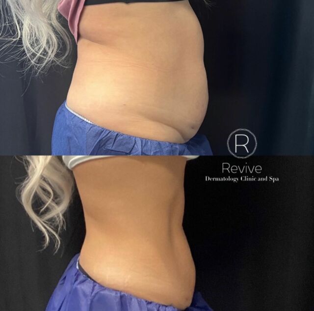 This patient had two rounds of CoolSculpting Elite. 4 cycles each time. She also is participating in our medically supervised weight loss program. Total weight loss 30 lbs. 🙀