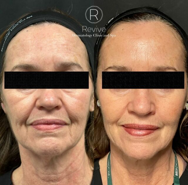 •BBL HERO•

This beauty decided to try out her very first aesthetics treatment! She is stunned with the results! We love this laser and always treat you to the advanced settings for the best results! Same day, same lighting, make-up free except for lip gloss!
👩🏼Amber Remsburg, Esthetician
@revive_aesthetics_by_amber
👩🏼Aubrey Robins, BSN
@revive_aesthetics_by_aubrey
👩🏼‍🦰Brianna Sandstrom, Esthetician
@briannasandstrom
👩🏼Lauren King, BSN
@revive_aesthetics_by_lauren
👩🏽Maria Gómez-Ceballos, Esthetician
@revive_aesthetics_by_maria
👩🏼‍⚕️Nikki Roetman, ARNP, FNP, PMHNP
@roetmannikki
👩🏽‍⚕️Stefanie Gatica, DNP, FNP,
@drstef_gatica_dnp
👩🏻‍⚕️Tawnya Bauch, ARNP, FNP
@revivederm_tawnya_dermtoxnp
——————————————————
Book with us here👇🏼👇🏼👇🏼👇🏼
☎️515-965-5677
🖥️reviveclinicandspa.com
📧Info@reviveclinicandspa.com
📍Ankeny, IA